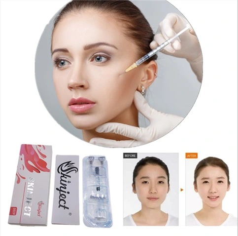 Skinject 1ml Cross Linked Ha Cheek Filling Deep Dermal Filler